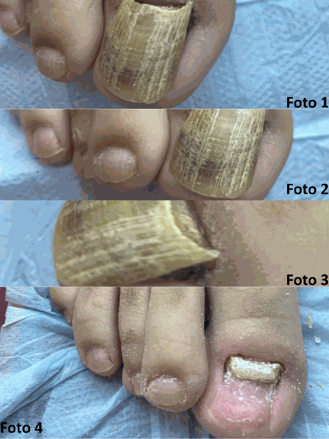 Laserterapia (Onicomicose)